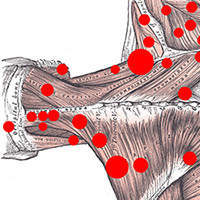 NMT for Trigger Points