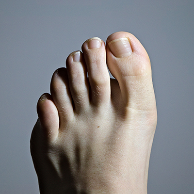 Tendon Strains of the Toes